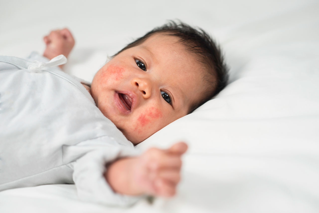 New born baby with skin rashes on the cheeks, inflamed skin of children with rash problems, Health concept.