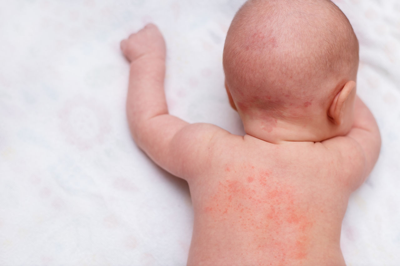 Miliaria, prickly heat on baby's back.